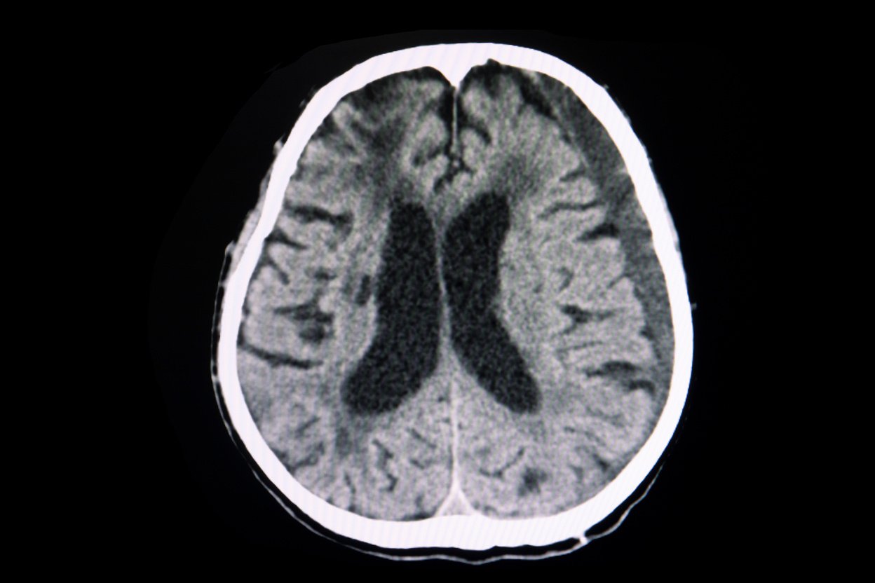 large subacute subdural hematoma